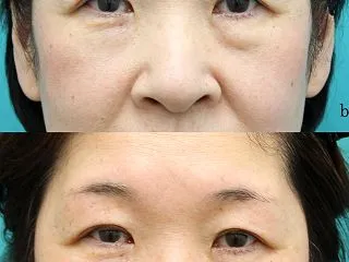 片方だけの裏ハムラ法（≒組み換え術）術後…