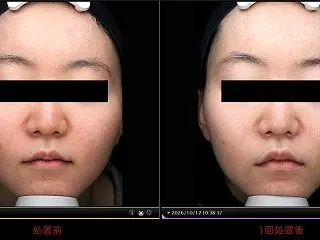 赤ら顔を治す「585nmレーザー」