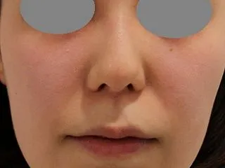 糸リフトって入れ続けたらどうなるんでしょ…