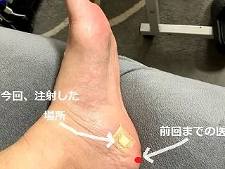 体外衝撃波治療ってご存じですか？