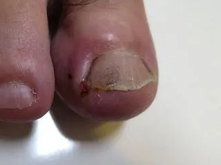 化膿性爪囲炎の症例です。
