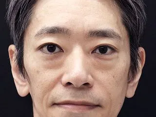40代男性 目の下たるみ手術後のダウンタ…