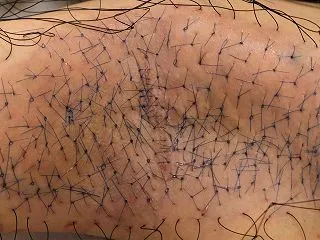 成人女性のワキガ（腋臭症）の剪除法手術で…