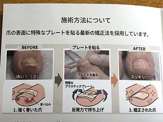 「巻き爪」施術をスタート！
