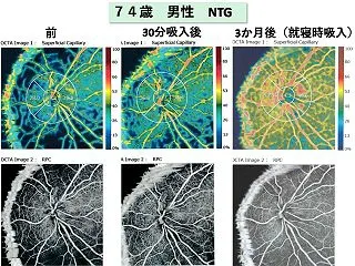 眼科医のつぶやき 第2909回 正常眼圧…