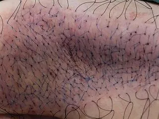 ワキ毛の範囲よりはるかに広いワキガ手術で…