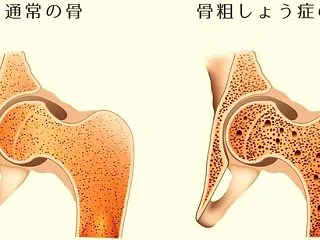 骨密度110% !