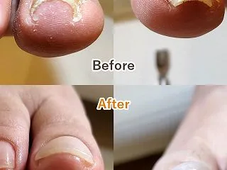 痛い巻き爪、どこに相談する？爪を切るのも…