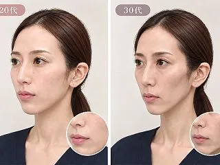 時を戻す感動のヒアルロン酸