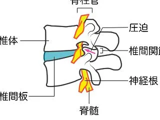 椎間板の問題は腰痛の原因？ 世界脊椎デー…