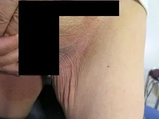 鼠径部白癬の症例です。