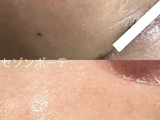 本日も AHAツヤ肌ピーリング