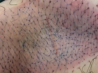 吸引法術後のワキガ再発｜アポクリン腺が多…