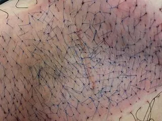 吸引法術後のワキガ再発｜アポクリン腺が多…