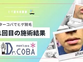 フレイアクリニックのヒゲ脱毛｜料金・効果…