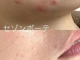 AHAツヤ肌ピーリング ニキビ