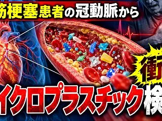 心筋梗塞患者の冠動脈から「マイクロプラ…