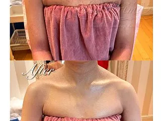 アトピーの色素沈着のボディメイク