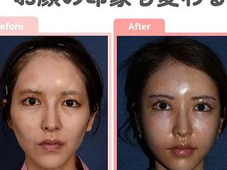 ✨脂肪注入 Before & A…
