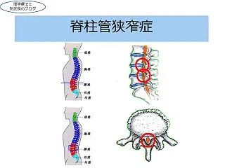 若年者の腰痛：腰部脊柱管狭窄症が増えてい…