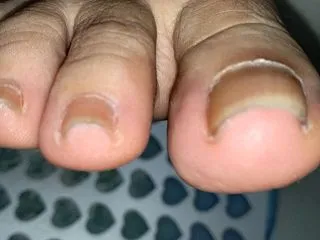 また巻き爪が…