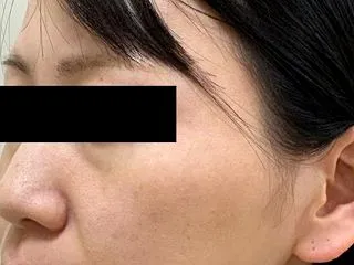 糸リフト ワンダートリプル 始めました！