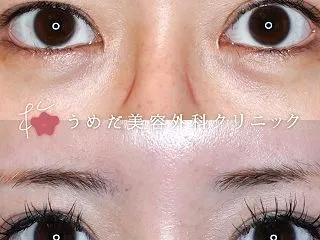 骨切り手術後の過矯正を治す
