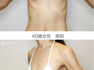 体重37kgから脂肪吸引で1020cc