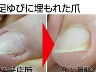 ペディグラス巻き爪補正スクールのご案内