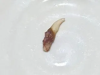 【食べたくても～痛みから解放】 歯周病：…