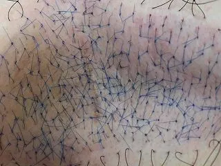 当院でワキガ手術を受けて治られた方のブロ…