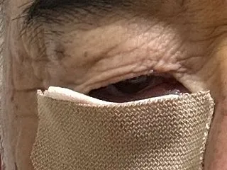 右眼の手術