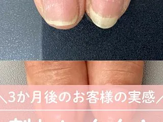 割れにくくなったと実感！自爪育成3か月｜…