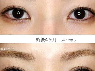 他院修正で二重の幅を調整する