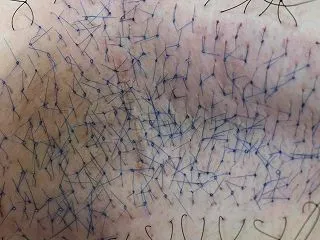 当院でワキガ手術を受けて治られた方のブロ…