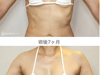 52歳・セリューション豊胸（7M）