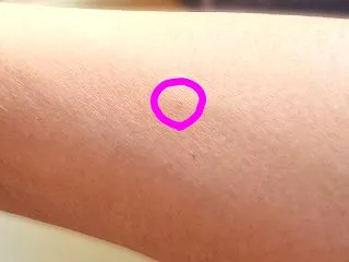 造影剤CT検査だったのですが