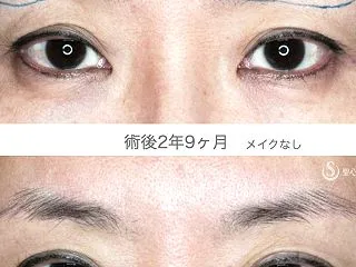 20年前の二重ラインに若返る