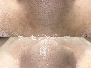 メディアクア毛穴エステ