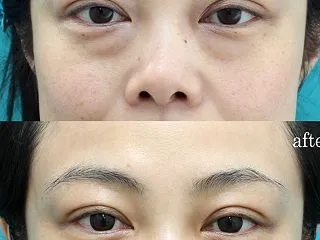 目の下のたるみを、手術で治したら なみだ…