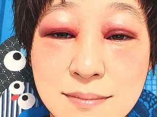 眼瞼下垂の手術を受けました