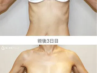 体重37kgで脂肪注入豊胸（3日目）