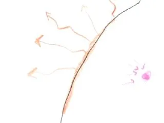 仮説／鍼灸は「風」、漢方は「石」