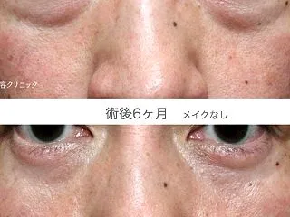 コレも札幌院の定番「ハムラ+α法」