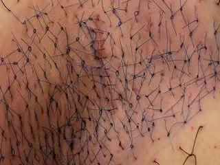 今回、ワキガ剪除法手術を受けられたのはド…