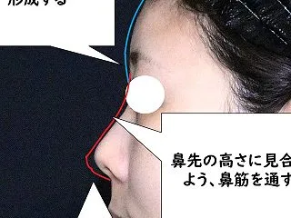 肋軟骨鼻フル＋彫り形成 術後10ヵ月
