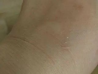 季節外れの蚊に刺されて