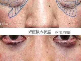 続・男性の目の下のクマ治療
