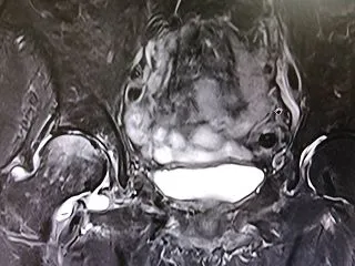 70代女性 股関節の痛み【3回目】MRI…