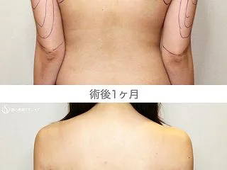 スタッフ④「二の腕ベイザー」1M後